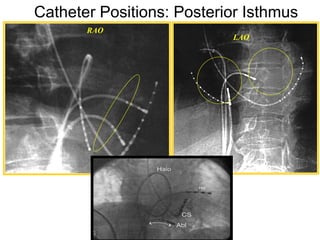 Catheter Positions: Posterior Isthmus
            RAO
                                LAO




36
 