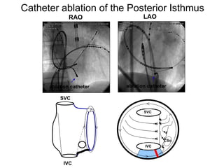 Catheter ablation of the Posterior Isthmus
                   RAO                LAO




           ablation catheter   ablation catheter

               SVC

                                      SVC




                                              CSo
                                       IVC


37
                IVC
 