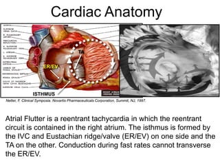 Cardiac Anatomy

                                           TA


                      ER/EV




                ISTHMUS
Netter, F. Clinical Symposia. Novartis Pharmaceuticals Corporation, Summit, NJ, 1997.




Atrial Flutter is a reentrant tachycardia in which the reentrant
circuit is contained in the right atrium. The isthmus is formed by
the IVC and Eustachian ridge/valve (ER/EV) on one side and the
TA on the other. Conduction during fast rates cannot transverse
the ER/EV.
  4
 