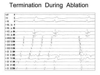 Termination During Ablation




42
 