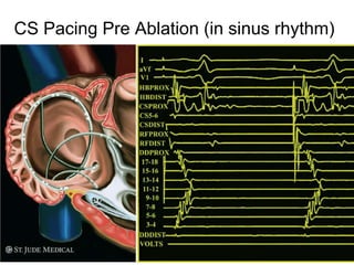 CS Pacing Pre Ablation (in sinus rhythm)




43
 