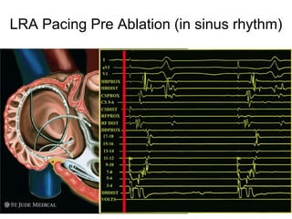 LRA Pacing Pre Ablation (in sinus rhythm)




44
 