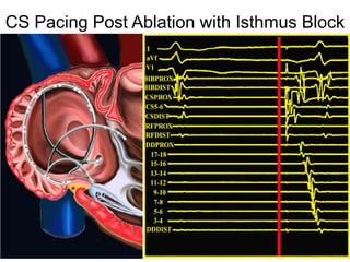 CS Pacing Post Ablation with Isthmus Block




 46
 
