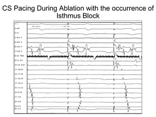 CS Pacing During Ablation with the occurrence of
                Isthmus Block




 47
 