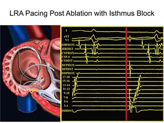 LRA Pacing Post Ablation with Isthmus Block




48
 