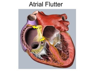 Atrial Flutter




5
 