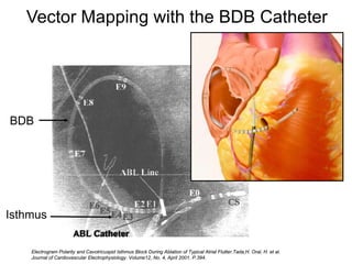 Vector Mapping with the BDB Catheter




BDB




Isthmus
                         ABL Catheter
 51   Electrogram Polarity and Cavotricuspid Isthmus Block During Ablation of Typical Atrial Flutter.Tada,H. Oral, H. et al.
      Journal of Cardiovascular Electrophysiology. Volume12, No. 4, April 2001. P.394.
 