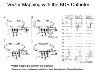 Vector Mapping with the BDB Catheter




      Vector mapping to confirm the blockline
52    (Electrogram Polarity and Cavotricuspid Isthmus Block During Ablation of Typical Atrial Flutter）
 