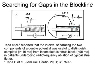 Searching for Gaps in the Blockline
               <90                         >110
               ms                          ms




Tada et al.* reported that the interval separating the two
components of a double potential was useful to distinguish
complete (>110 ms) from incomplete isthmus block (<90 ms)
in patients undergoing radiofrequency ablation of typical atrial
flutter.
* Tada H et al. J Am Coll Cardiol 2001; 38:750-5
54
 