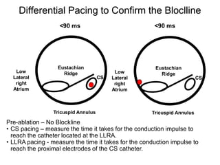 Differential Pacing to Confirm the Bloclline
                   <90 ms                             <90 ms




                   Eustachian                          Eustachian
   Low               Ridge                 Low           Ridge
  Lateral                            CS   Lateral                        CS
   right                                   right
  Atrium                                  Atrium



                 Tricuspid Annulus                   Tricuspid Annulus

Pre-ablation – No Blockline
• CS pacing – measure the time it takes for the conduction impulse to
  reach the catheter located at the LLRA.
• LLRA pacing - measure the time it takes for the conduction impulse to
  reach the proximal electrodes of the CS catheter.
 55
 