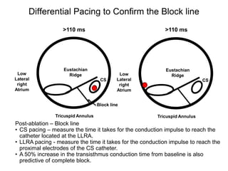 Differential Pacing to Confirm the Block line
                     >110 ms                                 >110 ms




                     Eustachian                              Eustachian
  Low                  Ridge                   Low             Ridge
 Lateral                              CS      Lateral                         CS
  right                                        right
 Atrium                                       Atrium


                                     Block line

                 Tricuspid Annulus                        Tricuspid Annulus
  Post-ablation – Block line
  • CS pacing – measure the time it takes for the conduction impulse to reach the
    catheter located at the LLRA.
  • LLRA pacing - measure the time it takes for the conduction impulse to reach the
    proximal electrodes of the CS catheter.
  • A 50% increase in the transisthmus conduction time from baseline is also
56 predictive of complete block.
 
