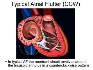 Typical Atrial Flutter (CCW)




  In typical AF the reentrant circuit revolves around
6 the tricuspid annulus in a counterclockwise pattern
 