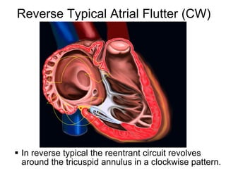 Reverse Typical Atrial Flutter (CW)




   In reverse typical the reentrant circuit revolves
7
    around the tricuspid annulus in a clockwise pattern.
 