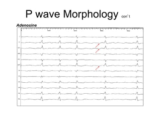 P wave Morphology   con’t

    Adenosine




9
 