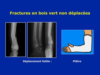 Fractures en bois vert non déplacées
Déplacement faible : Plâtre
 