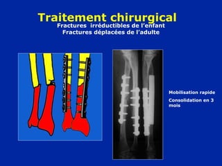 Fractures irréductibles de l’enfant
Fractures déplacées de l’adulte
Traitement chirurgical
Mobilisation rapide
Consolidation en 3
mois
 