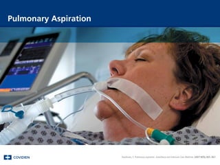 Rawlinson, E. Pulmonary aspiration. Anesthesia and Intensive Care Medicine. 2007:8(9);365-367.
Pulmonary Aspiration
 