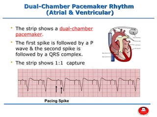 Comprehensive Overview of Cardiac Pacemakers and Implantable ...
