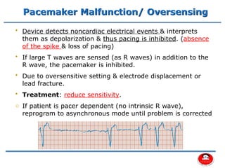 Decrease Sensitivity Pacemaker Comprehensive Overview of Cardiac Pacemakers and Implantable ...