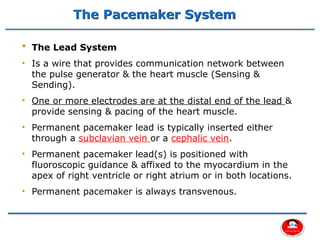 Distal Pacemaker Comprehensive Overview of Cardiac Pacemakers and Implantable ...