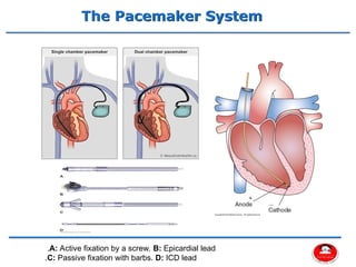 Comprehensive Overview of Cardiac Pacemakers and Implantable ...