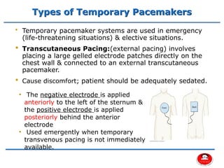 Comprehensive Overview of Cardiac Pacemakers and Implantable ...