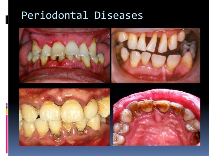 cigarette smoking launico