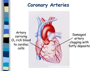 Coronary Arteries Artery carrying O 2  rich blood to cardiac cells Damaged artery clogging with fatty deposits 