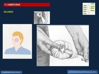 11. COBERTURAS


 OCLUSIVO




Jorge Almeida, Prof. Adj. - ESALD   UC Primeiros Socorros – CET Protecção Civil - 2012
 
