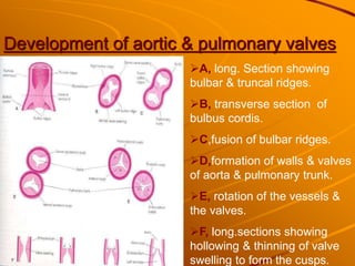 Development of aortic & pulmonary valves
A, long. Section showing
bulbar & truncal ridges.
B, transverse section of
bulbus cordis.
C,fusion of bulbar ridges.
D,formation of walls & valves
of aorta & pulmonary trunk.
E, rotation of the vessels &
the valves.
F, long.sections showing
hollowing & thinning of valve
swelling to form the cusps.
 