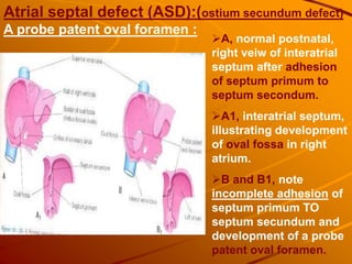 A, normal postnatal,
right veiw of interatrial
septum after adhesion
of septum primum to
septum secondum.
A1, interatrial septum,
illustrating development
of oval fossa in right
atrium.
B and B1, note
incomplete adhesion of
septum primum TO
septum secundum and
development of a probe
patent oval foramen.
Atrial septal defect (ASD):(ostium secundum defect)
A probe patent oval foramen :
 