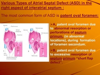 Various Types of Atrial Septal Defect (ASD) in the
right aspect of interatrial septum :
A, patent oval foramen due
to abnormal resorption or
perforations of septum
primum, (in abnormal
locations), during formation
of foramen secondum.
B, patent oval foramen due
to excessive resorption of
septum primum ‘’short flap
defect’’.
The most common form of ASD is patent oval foramen:
 