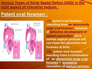 Various Types of Atrial Septal Defect (ASD) in the
right aspect of interatrial septum :
D, patent oval foramen
resulting from a combination
of an abnormally large oval
foramen + excessive
resorption of septum primum.
C, patent oval foramen
,resulting from an abnormally
large oval foramen because
of defective development of
septum secundum ,so a
normal septum primum will
not close the abnormal oval
foramen at birth.
Patent oval foramen :
 