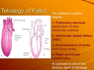 Tetralogy of Fallot : It contains 4 cardiac
defects :
1- Pulmonary stenosis
(obstruction of right
ventricular outflow).
2- Ventricular Septal Defect
(VSD).
3- Dextroposition of aorta
(overriding aorta).
4- Right ventricular
hypertrophy.
 cyanosis is one of the
obvious signs of tetralogy .
 