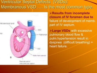 Ventricular Septal Defects (VSDs):
Membranous VSD …. Is the most common type.
Results from incomplete
closure of IV foramen due to
failure of development of memb.
part of IV septum.
Large VSDs with excessive
pulmonary blood flow &
pulm.hypertension result in
dyspnea (difficult breathing) +
heart failure.
 
