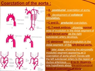Coarctation of the aorta :
A, postductal coarctation of aorta.
B, development of collateral
circulation.
C and D, preductal coarctation.
E, 7-week embryo, showing normal
area of involution in the distal segment of
right dorsal aorta as the right
subclavian artery develops.
F, abnormal area of involution in the
distal segment of the left dorsal aorta.
G, later stage, showing the abnormally
involuted segment appearing as a
coarctation of aorta which moves with
the left subclavian artery to the region of
ductus arteriosus….. E to G illustrate
one hypothesis about the embryological
basis of coarctation of aorta.
 