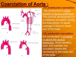 Coarctation of Aorta :
In postductal coarctation
, the constriction is distal
(below) to ductus arteriosus.
This permits development of
a collateral circulation during
the fetal period to assist
passage of blood to lower
part of the body.
In preductal coarctation ,
the constriction is proximal
or above the ductus
arteriosus which remains
open and maintain the
circulation (below the
narrowing) to the lower part
of the body.
 