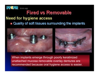 Overlay Temporary Denture 11.edent mand overlay dentures | PDF