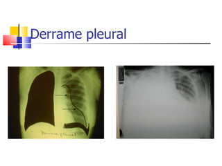 Derrame pleural 