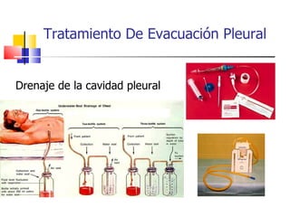 Tratamiento De Evacuación Pleural Drenaje de la cavidad pleural 