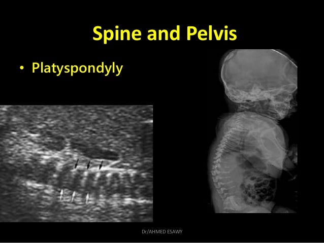 11-Fetal skeletal system part 1 Dr Ahmed Esawy diagram of fetus at 4 weeks 
