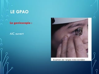 LE GPAO
La gonioscopie :
AIC ouvert
 