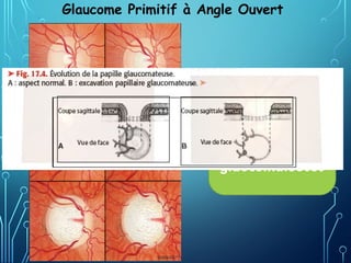 Progression
d'altérations
glaucomateuses
Glaucome Primitif à Angle Ouvert
 
