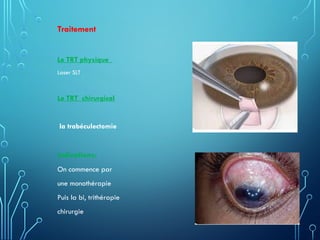 Traitement
Le TRT physique
Laser SLT
Le TRT chirurgical
la trabéculectomie
Indications:
On commence par
une monothérapie
Puis la bi, trithérapie
chirurgie
 