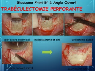 TRABÉCULECTOMIE PERFORANTE
Volet scléral superficiel Trabéculectomie pt dite Iridectomie basale
Sutures du volet scléral Volet scléral suturé
Glaucome Primitif à Angle Ouvert
 