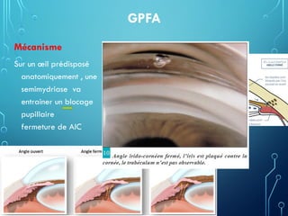 GPFA
Mécanisme
Sur un œil prédisposé
anatomiquement , une
semimydriase va
entrainer un blocage
pupillaire
fermeture de AIC
 