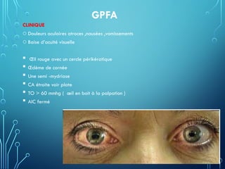 GPFA
CLINIQUE
o Douleurs oculaires atroces ,nausées ,vomissements
o Baise d’acuité visuelle
 Œil rouge avec un cercle périkératique
 Œdème de cornée
 Une semi -mydriase
 CA étroite voir plate
 TO > 60 mmhg ( œil en boit à la palpation )
 AIC fermé
 