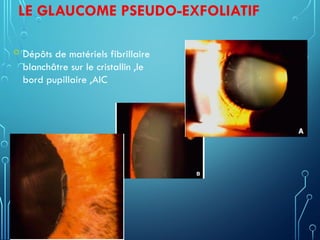 LE GLAUCOME PSEUDO-EXFOLIATIF
 Dépôts de matériels fibrillaire
blanchâtre sur le cristallin ,le
bord pupillaire ,AIC
 