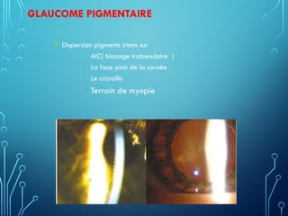 GLAUCOME PIGMENTAIRE
 Dispersion pigments iriens sur
• AIC( blocage trabeculaire )
• La face post de la cornée
• Le cristallin
• Terrain de myopie
 