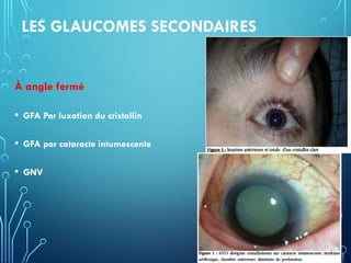 LES GLAUCOMES SECONDAIRES
À angle fermé
• GFA Par luxation du cristallin
• GFA par cataracte intumescente
• GNV
 